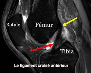 Ligament croisé antérieur normal sur une IRM