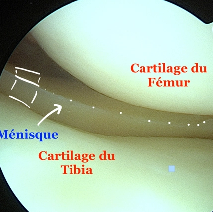 Arthroscopie du genou : cartilage et ménisque