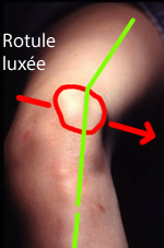Photo d'un genou avec la rotule luxée