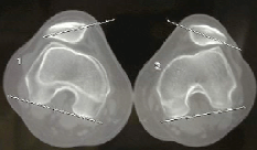 scanner des deux genoux avec instabilité bilaterale des rotules