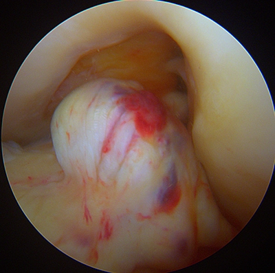 Image sous arthroscopie d'un cyclope, fibres rompues du ligament croisé antérieur gènant l'extension du genou