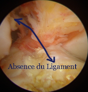 Photo sous arthroscopie d'une rupture du ligament croisé antérieur