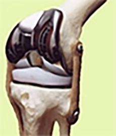 les composants d'une prothèse totale de genou