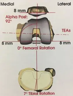 Feuille de programmation pré-opératoire d'une prothèse du genou