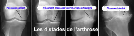 L'arthrose unicompartimentale du genou - Orthèses Biomec